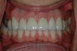 AFTER - 10 Upper Teeth Restored - Ceramic Veneers - Prosthodontics on Chamberlain - Ottawa Implants