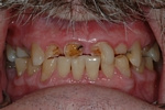 BEFORE - Fractured Upper Teeth due to an extreme Bruxism/Grinding habit