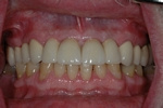 AFTER - Upper Teeth Restored with Ceramic Crowns and six Implants - Prosthodontics on Chamberlain 