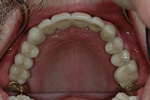 AFTER - Upper Teeth Restored with Ceramic Crowns - Prosthodontics on Chamberlain, Ottawa