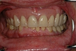 AFTER - Upper partial denture retained by two implants - OTTAWASMILE
