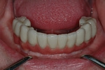 AFTER - Final full bridge fixed to 5 lower dental implants - Prosthodontics on Chamberlain 