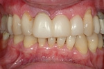 BEFORE - Failing upper teeth due to periodontal disease 