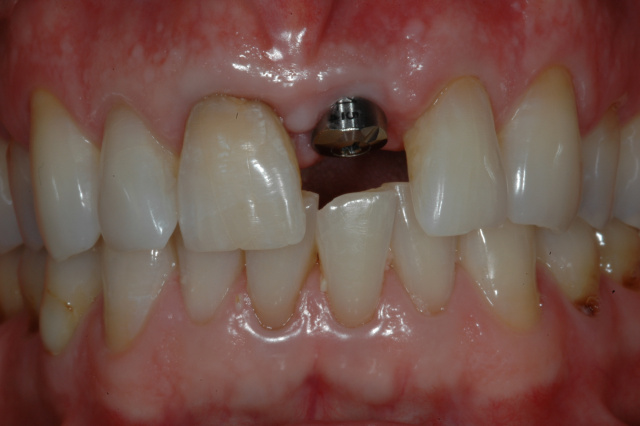 Case 2 - Before -Single Anterior Implant