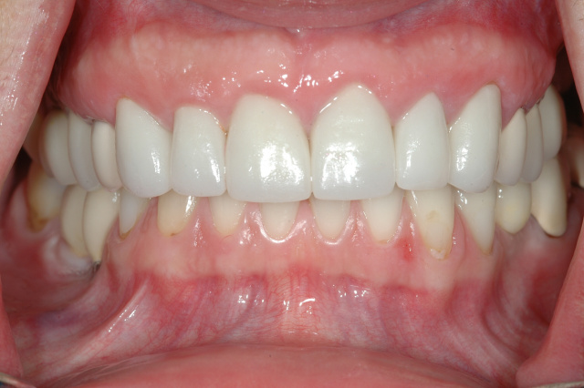 Case 2 - AFTER -Restored smile