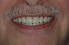 CASE 2 -AFTER -Full upper and lower dentures