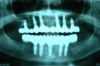 Case 4 - BEFORE - X-Ray showing 11 Implants 