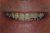 CASE 4 - BEFORE - Discoloured and Crowded Teeth