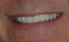 CASE 4 - AFTER - Final smile with upper veneers