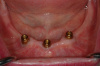 CASE 3 -BEFORE -3 Lower Implants with Attachments