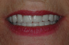 CASE 3 -AFTER -New Smile with Dentures