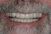 Case 3 - AFTER -full mouth reconstruction 