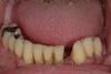 Case 1 - Before - Hopeless Lower Teeth 