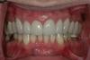 CASE 1 -AFTER with CERAMIC VENEERS