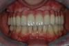 Case 2 - AFTER - Final Upper Implant-Bridge 