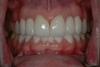 CASE 2 -AFTER with ceramic bridges