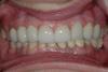 CASE 1 -AFTER -Ceramic Veneers and Single Implants