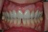 CASE 1 -AFTER -Ceramic Veneers 