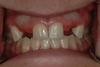 CASE 1 -BEFORE with missing lateral incisors