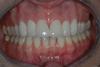 CASE 4 - AFTER - 6 New Crowns