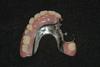 CASE 1 -AFTER -partial denture