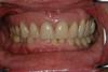 CASE 1 -AFTER with partial denture