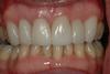 CASE 2 -AFTER with ceramic veneers