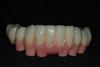 Case 3 - Final Ceramic bridge with pink gingiva