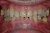 Case 3 -BEFORE -Severe wear on all the teeth