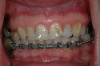 Case 2 - BEFORE - heavily worn and crowded teeth