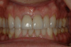 Case 2 - After -Two Ceramic Crowns 